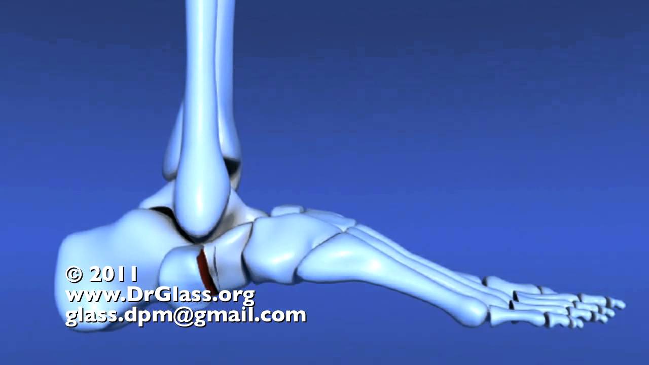 Evans Calcaneal Osteotomy of the Flat Foot