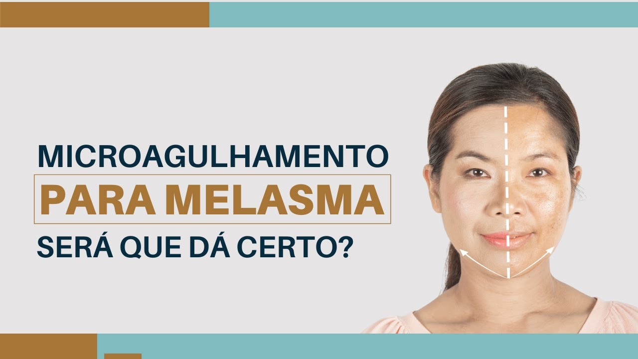 Microagulhamento para melasma?