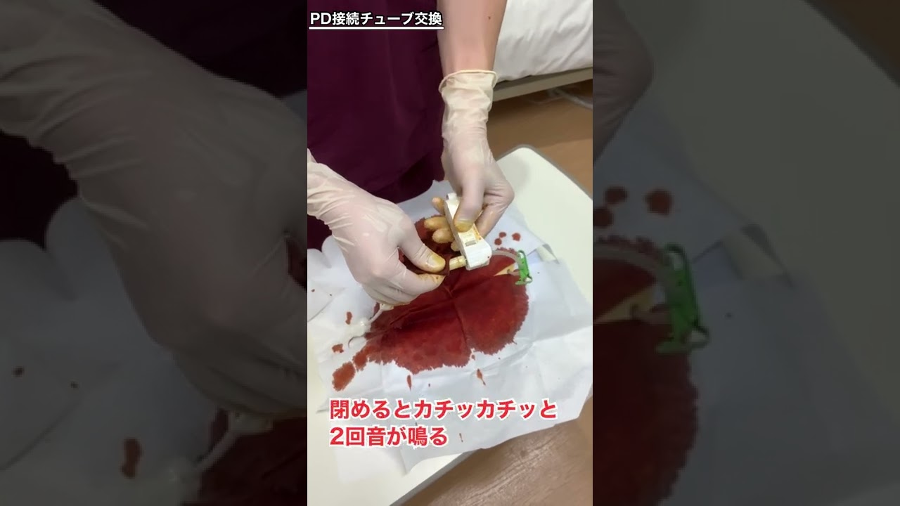 PDチューブ交換