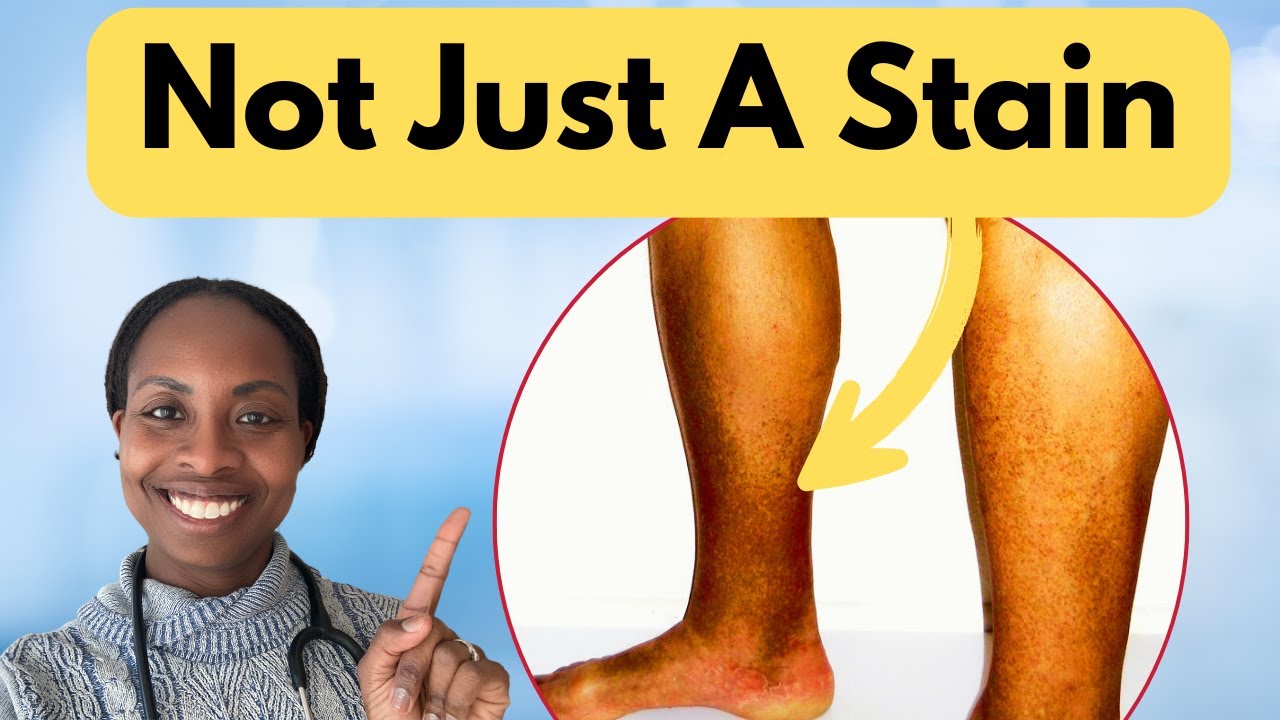 Brown Stains on Skin? Doctor Explains Hemosiderin Staining