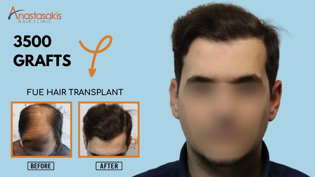 🎥 9-Month Hair Transplant Check-Up with 3500 Grafts | Anastasakis Hair Clinic 🌟 Case #296