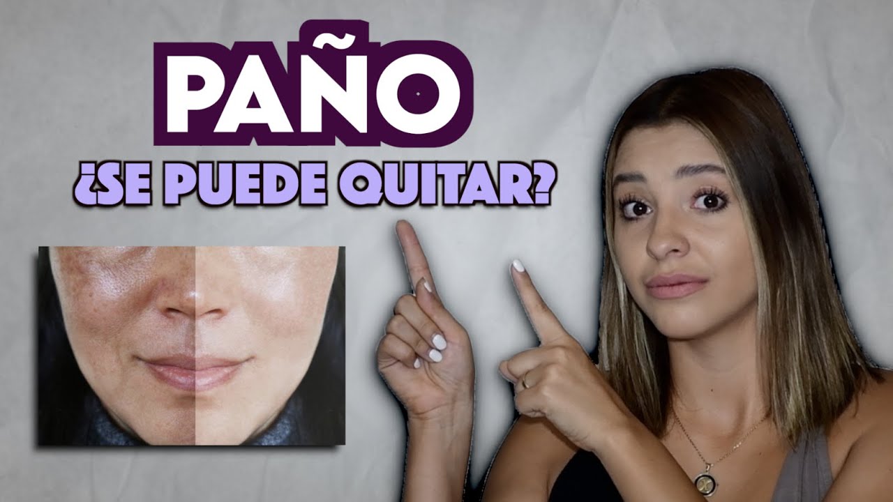 PAÑO O MELASMA II CAUSAS, TRATAMIENTO, SKINCARE  - Ximena Ramaya