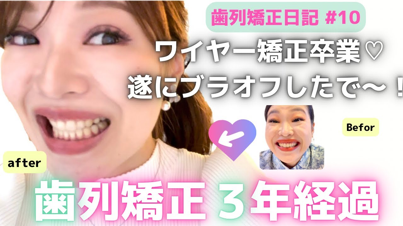 【歯列矯正日記#10】3年目で遂にブラオフ！ワイヤー矯正卒業！しかしまだ2年マウスピース矯正が続くよの巻