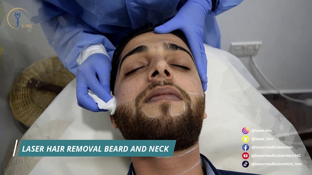 LMC LHR Beard shaping - إزالة شعر اللحية عن طريق الليزر 