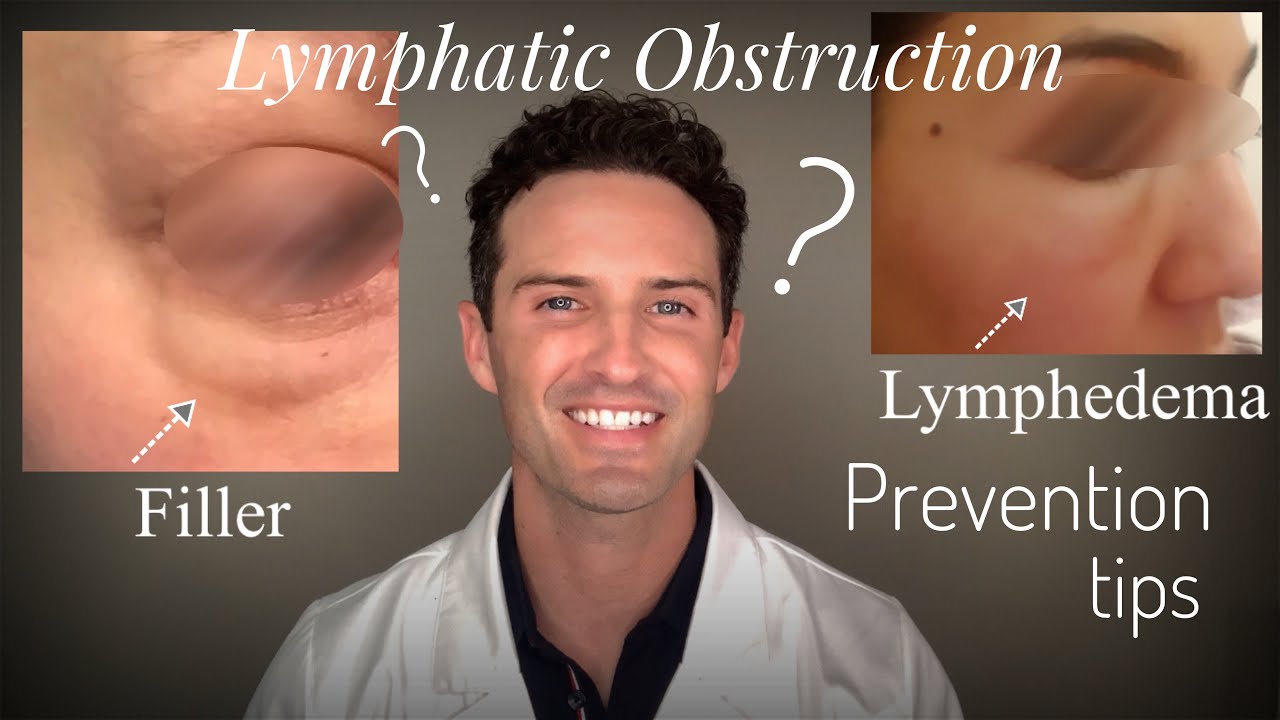 Tear trough swelling. Help! Lymphatic obstruction & prevention techniques.