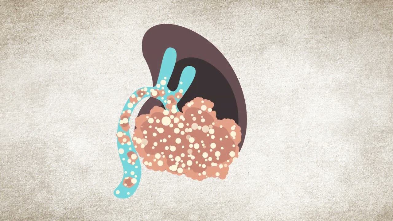 Cos'&egrave; il cancro al rene? | National Kidney Foundation