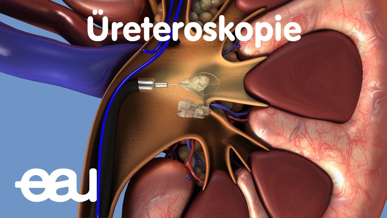 Tedavi böbrek ve üreteral taşlari: Üreteroskopi (URS)