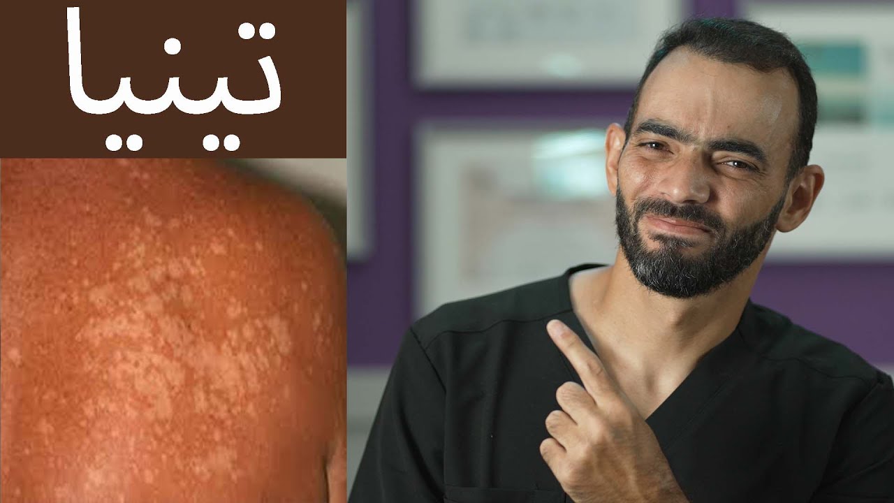 تينيا