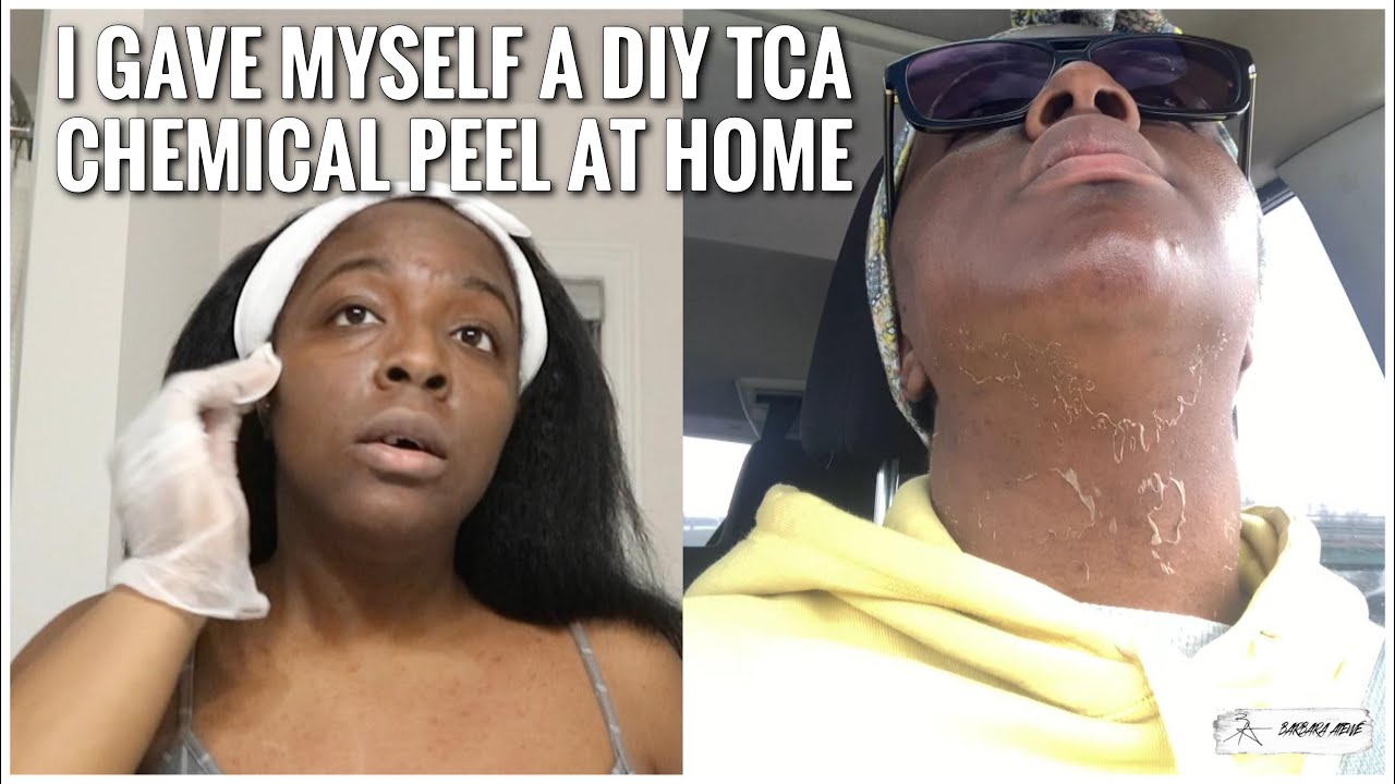 I GAVE MYSELF A DIY 15% TCA CHEMICAL PEEL AT HOME | ACNE SCARS & HYPERPIGMENTATION | Barbara Atewe