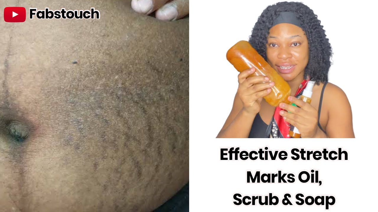 Say Goodbye To Stretch Marks With this Stretch Marks Set Recipe | Stretch Marks Soap,Oil & Scrub