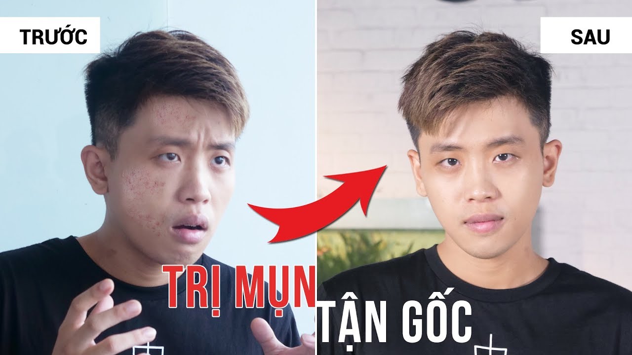 3 Nguyên Tắc Cần Nhớ Nếu Muốn Trị Mụn Tận Gốc Thành Công | 30Shine Bí Quyết Đẹp Trai 55