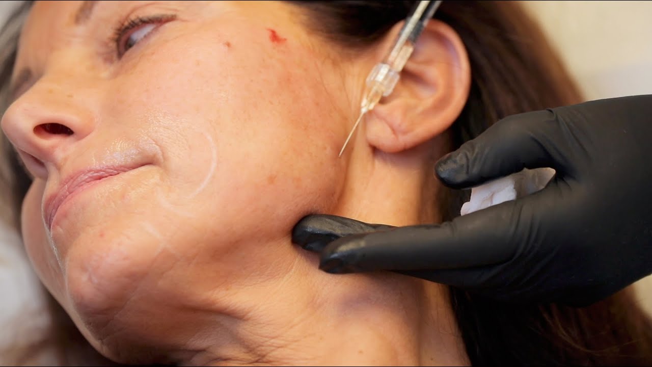 Dr. Natalie Keller – Hyaluronsäure-Behandlung des alternden Gesichtes | Livebehandlung in Osnabrück