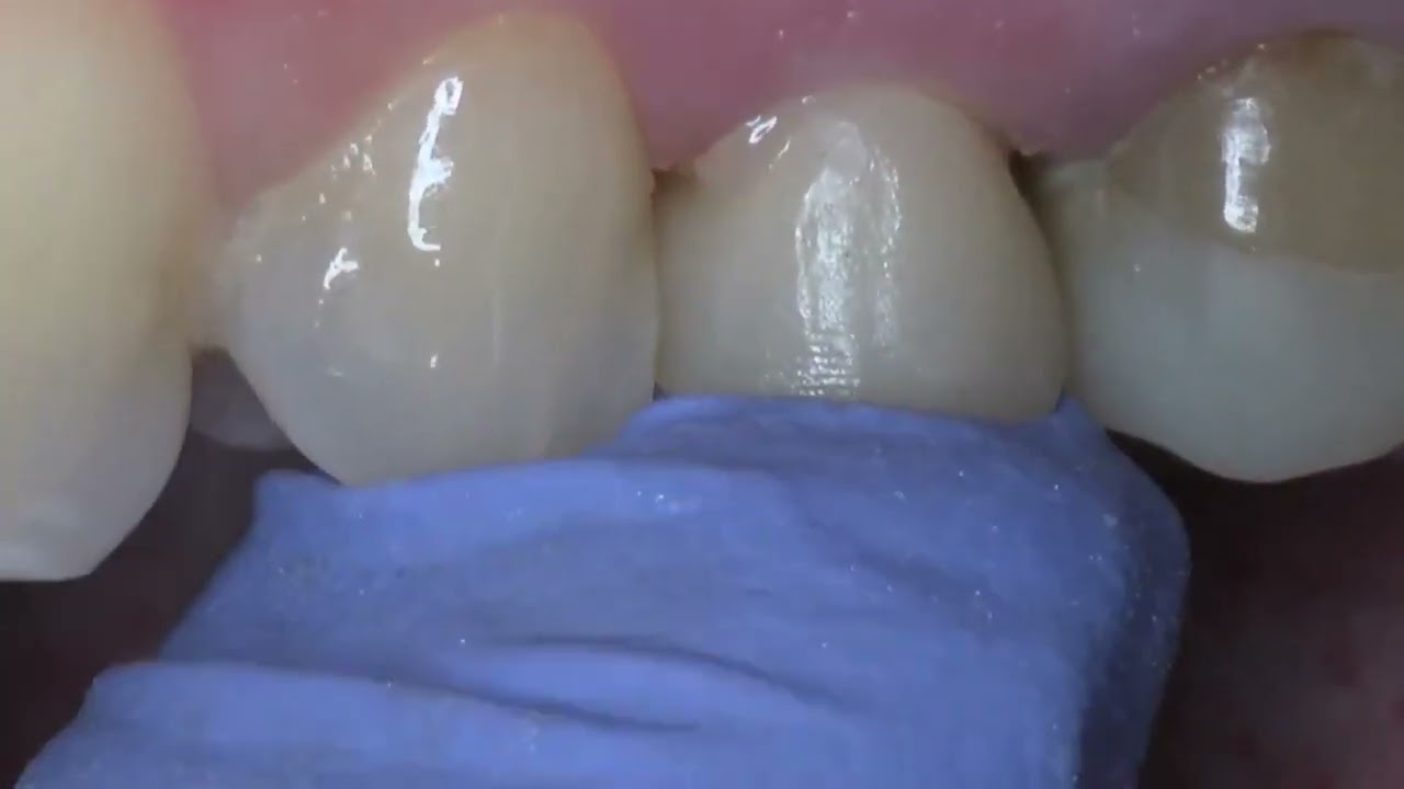 Tecnica di cementazione corona zirconia
