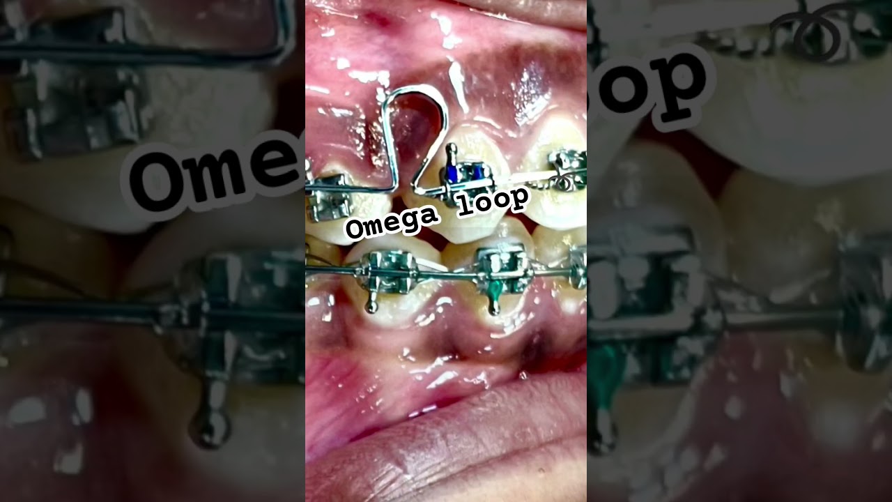 Omega loop &Omega; for retraction
