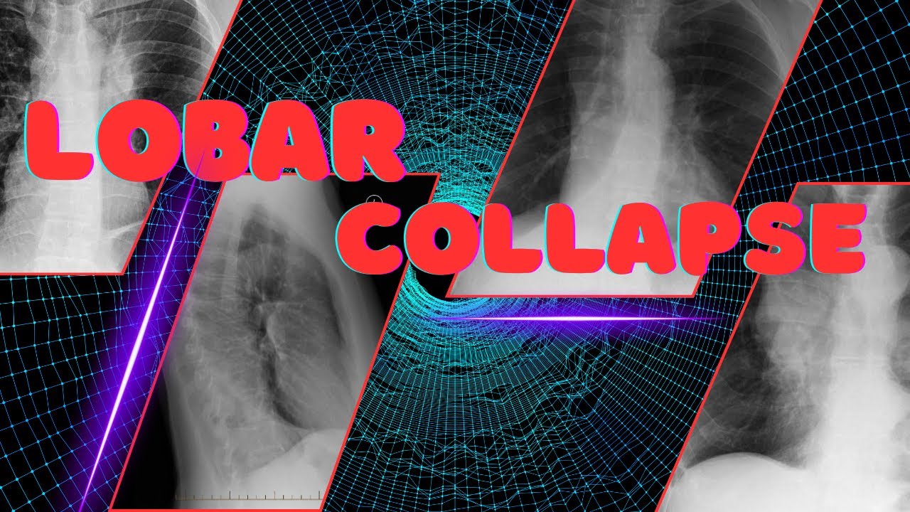 Lobar Collapse on X-ray