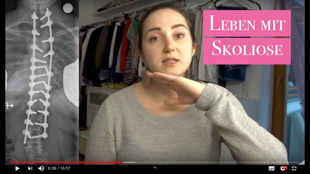 MEIN LEBEN MIT SKOLIOSE - MEINE OPERATION