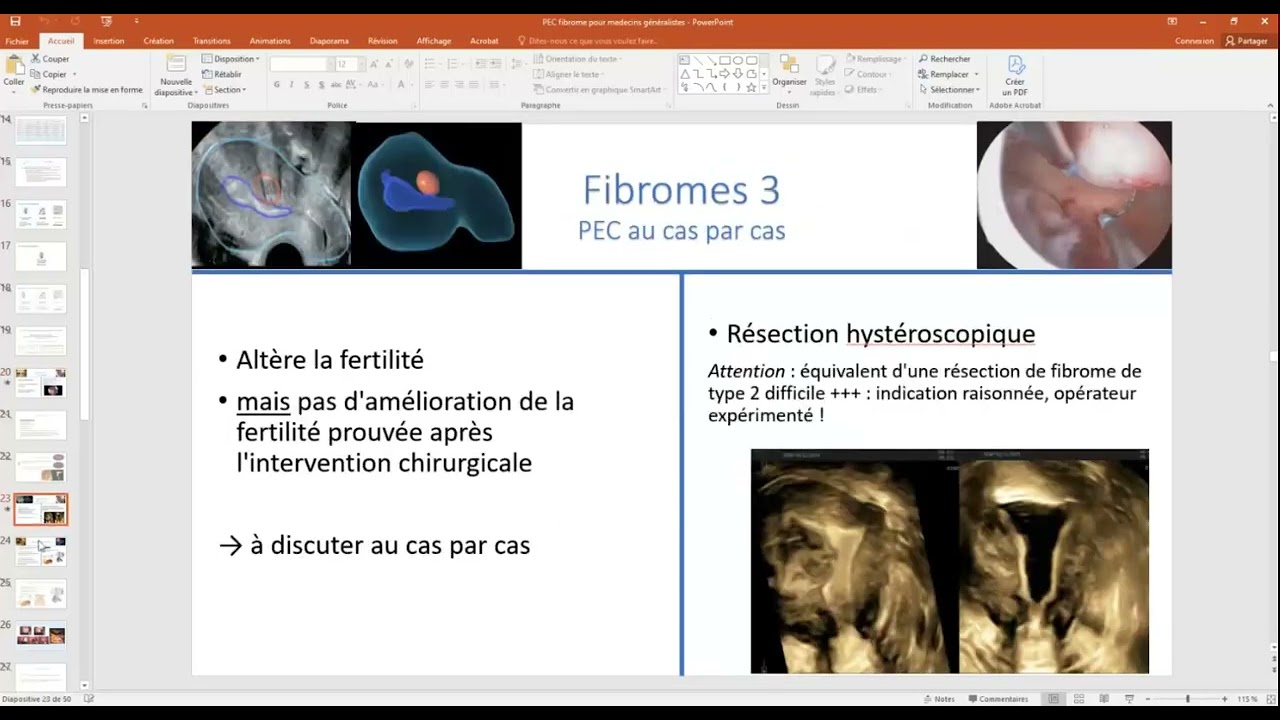 Fibromes Utérins - Prise en charge
