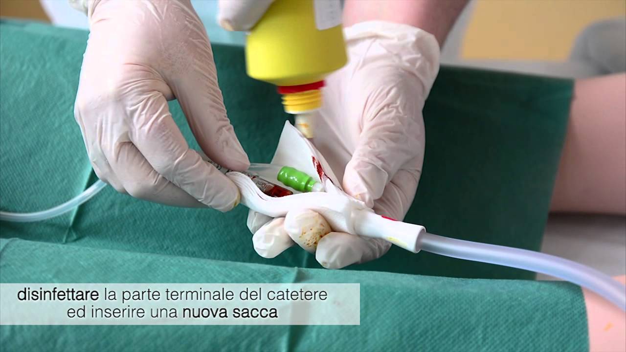 Ulss 1 Belluno - Catetere vescicale. Soluzioni alle possibili complicanze.