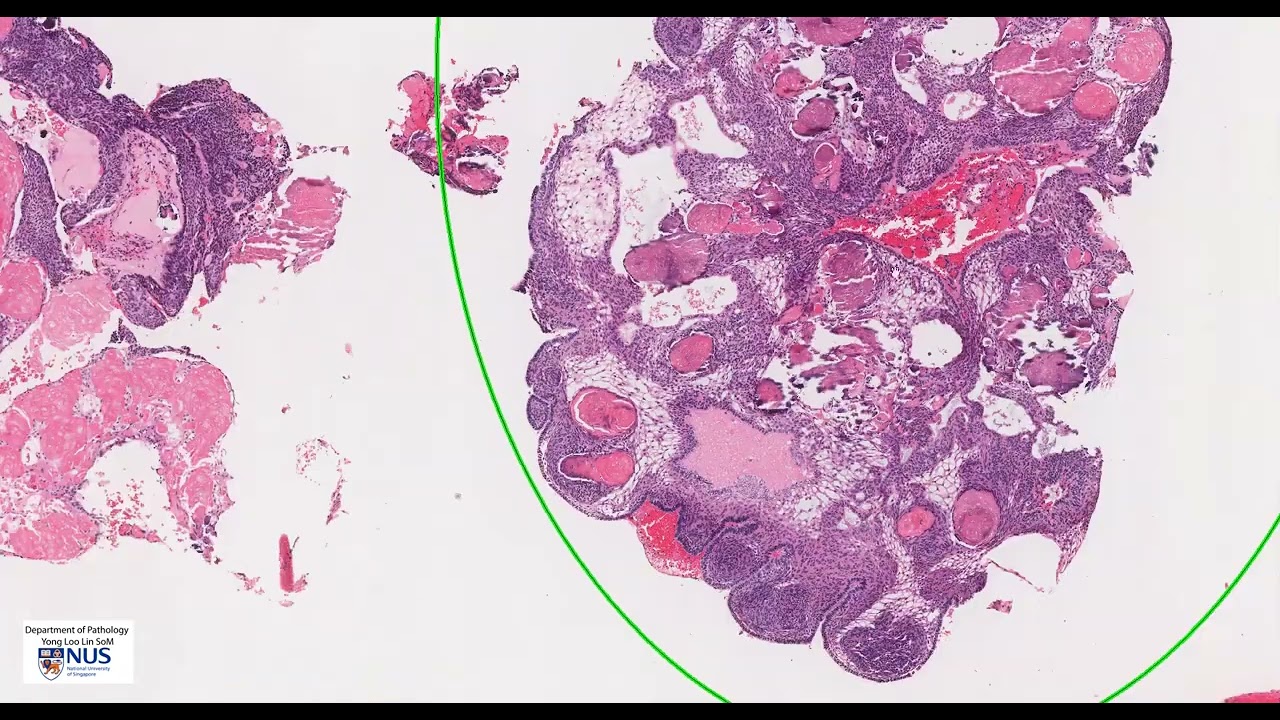 Craniopharyngioma (Adamantinomatous) microscopy - Talking slide
