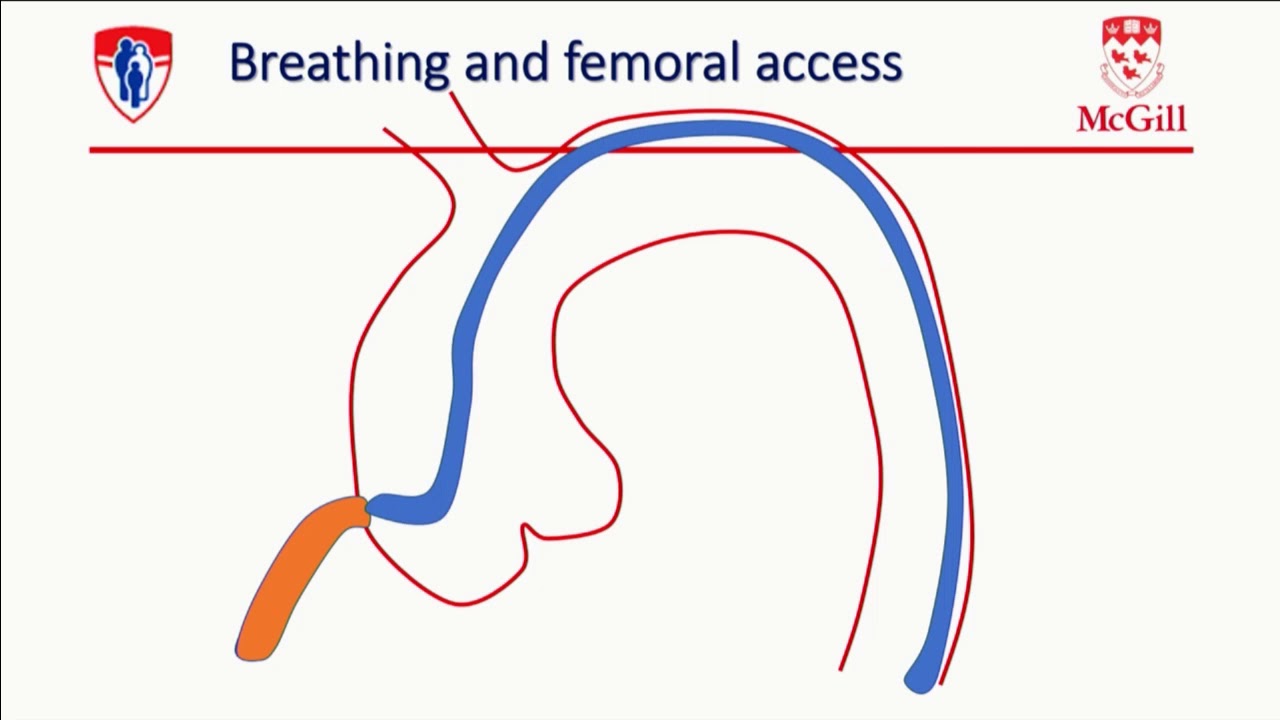 Radial CTO PCI - Stéphane Rinfret, MD