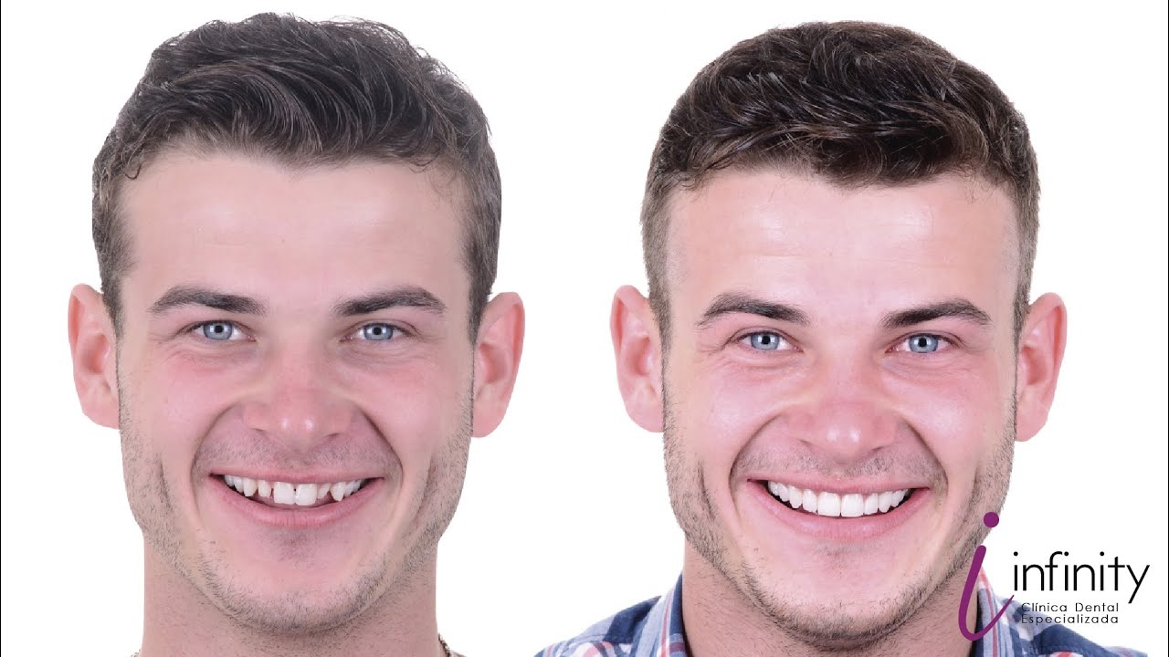 Transformación de sonrisa con carillas de porcelana - Smile transformation with porcelain veneers