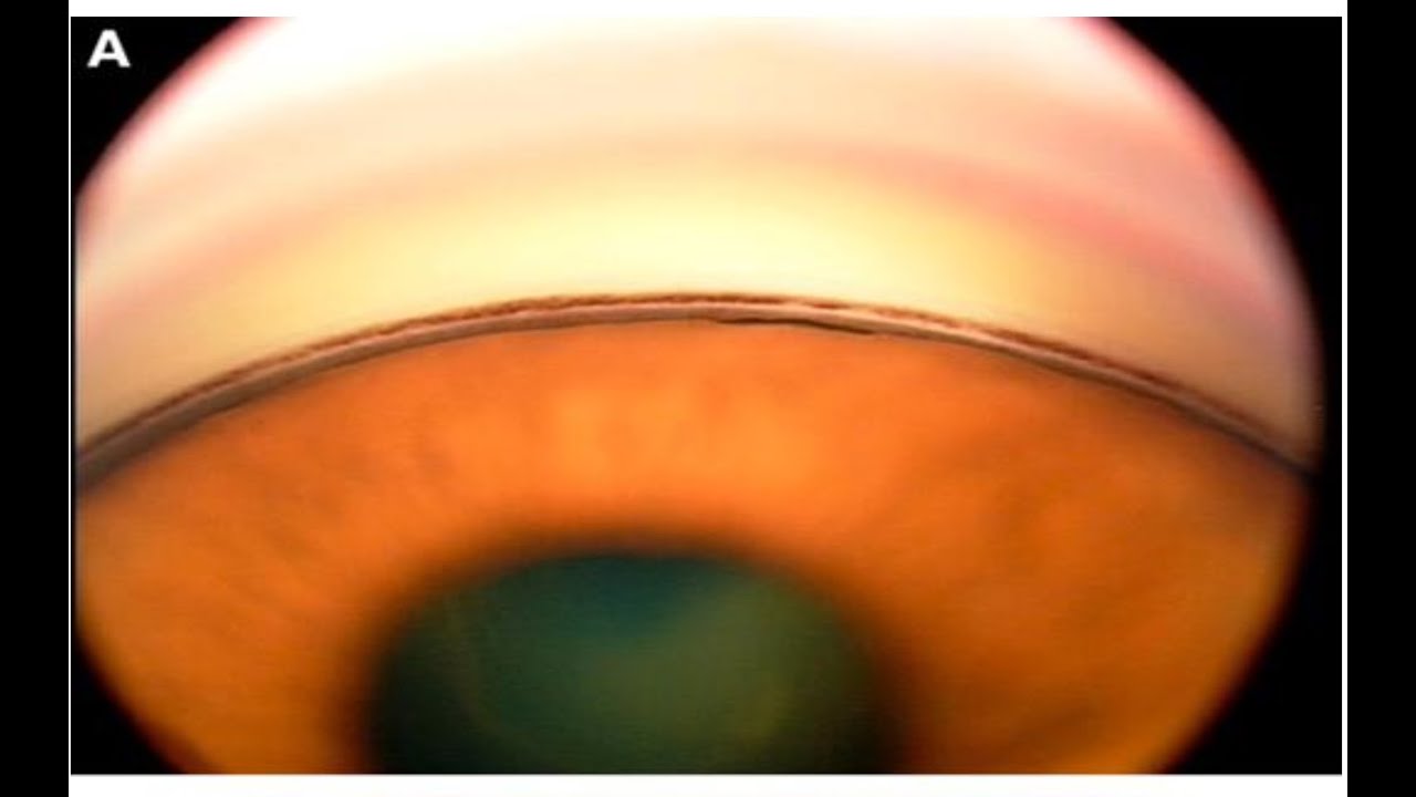 gonioscopy