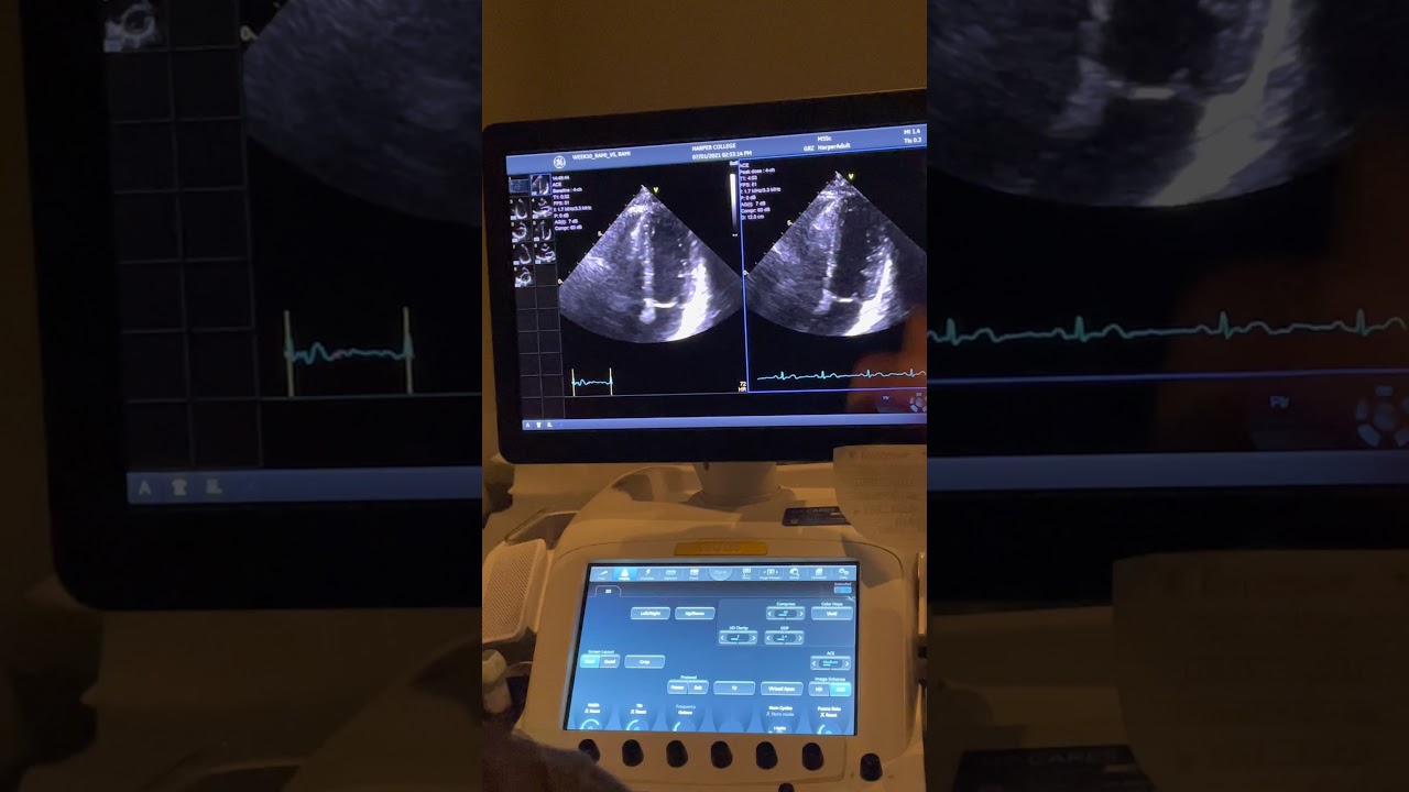 Dobutamine stress echo GE vivid