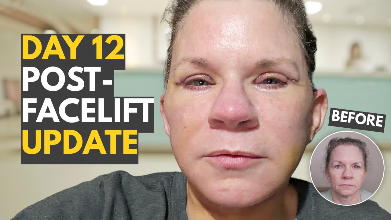 Day 12 After Facelift I Can’t Eat And My Face Is So Tight