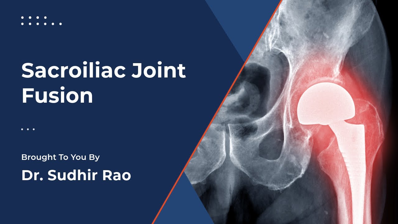 SI Joint Fusion  for SI Joint Dysfunction  |  A Minimally Invasive Procedure