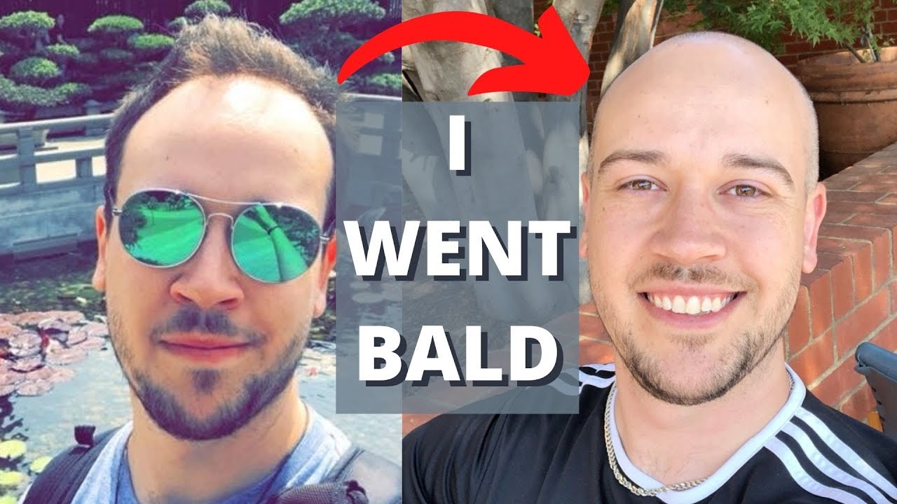 YEARS OF BALDING - How It Feels To Finally Be Bald In My 30's
