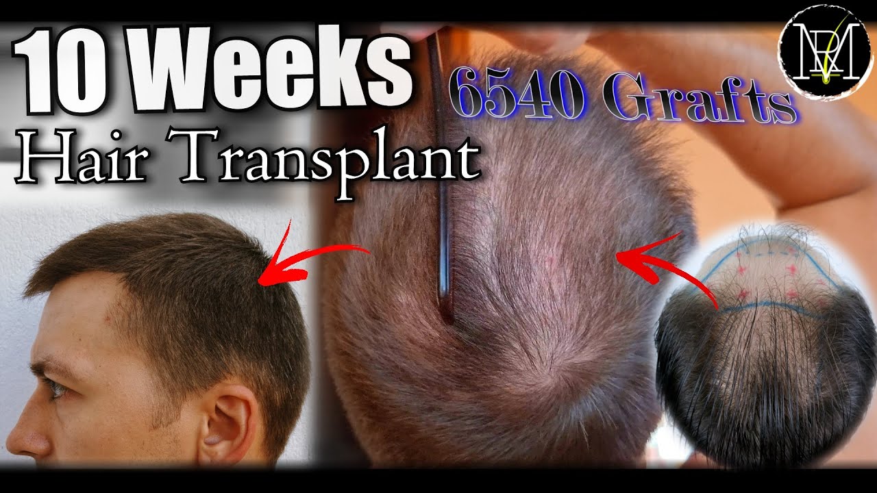 2.5 Months after 2nd FUE/DHI. 6500 Grafts, NW5a