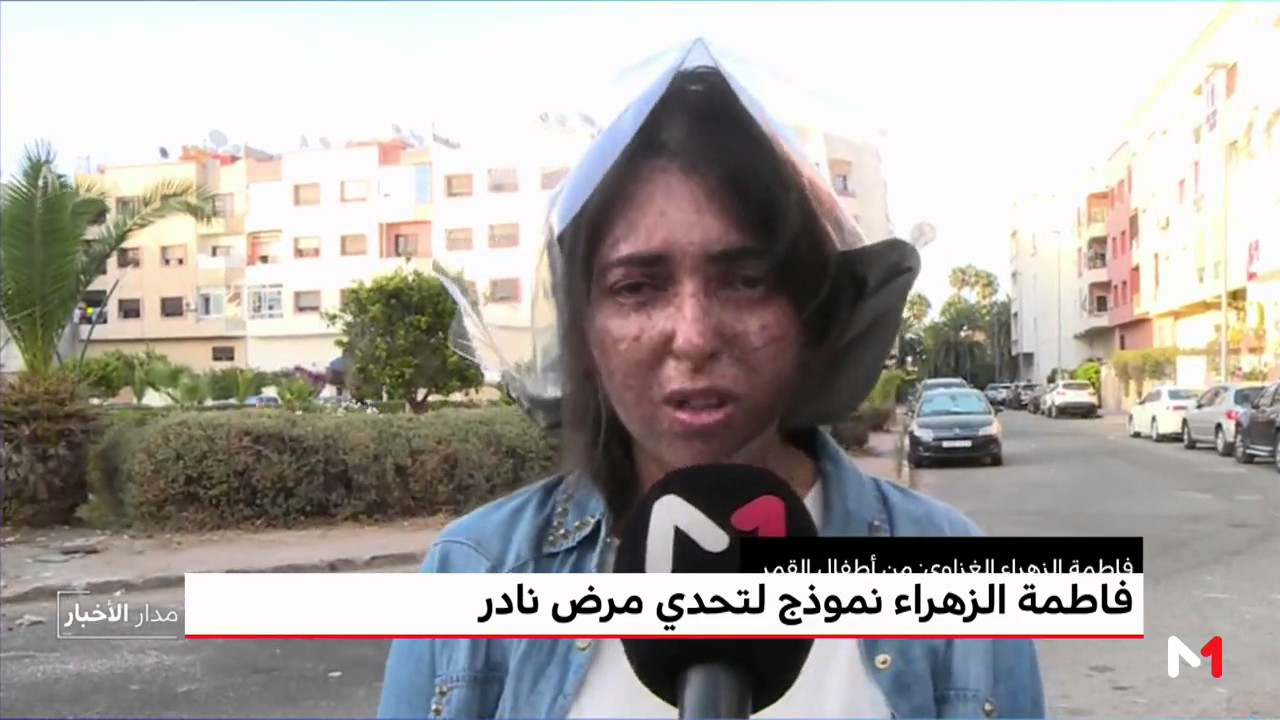 روبورتاج .. أطفال القمر يعانون في صمت ويتحدون المرض بعزيمة