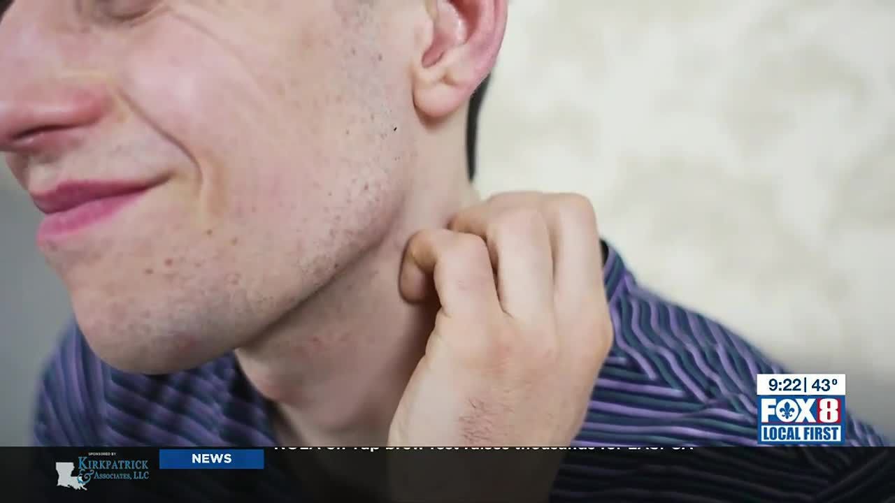 Treating eczema flare ups