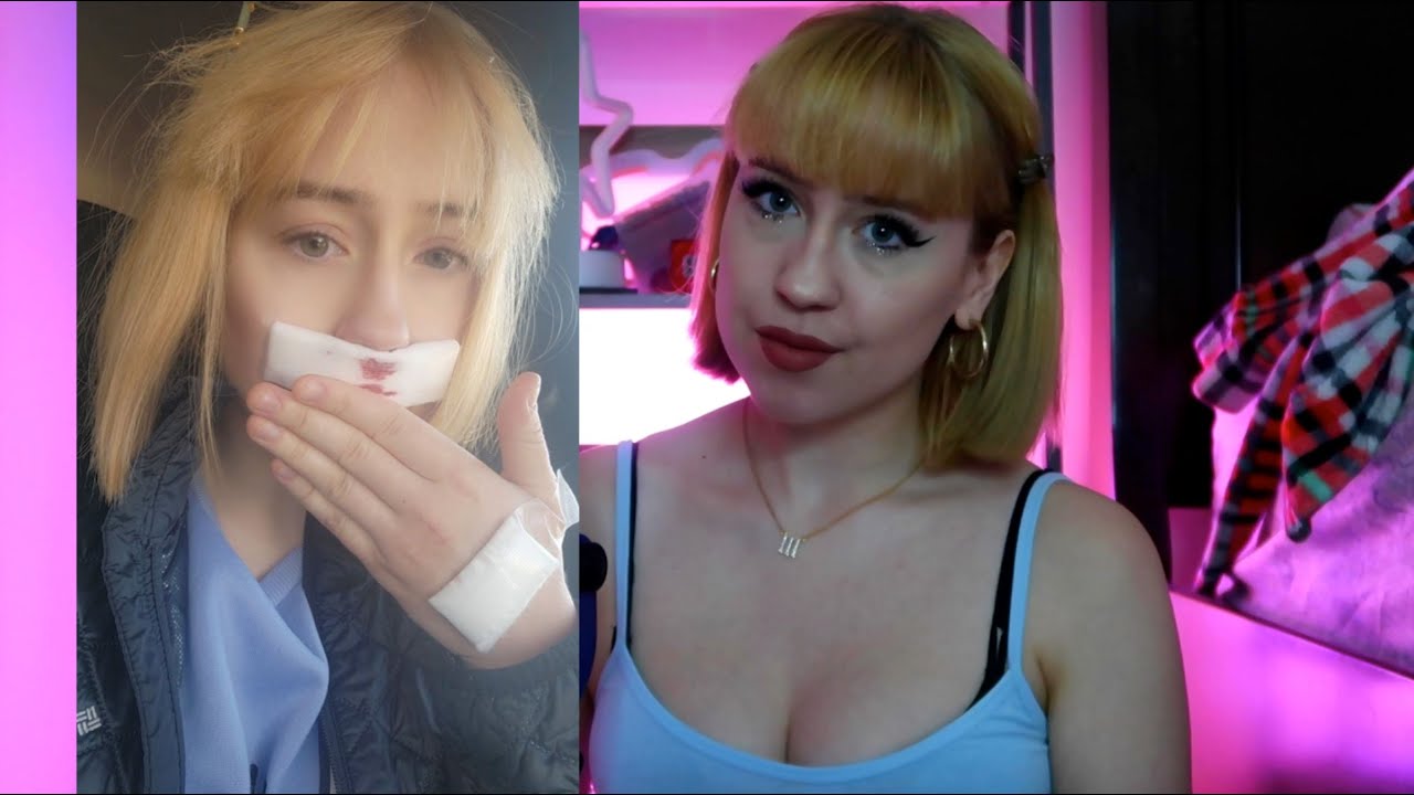 my septoplasty + turbinate reduction experience 👃🏼