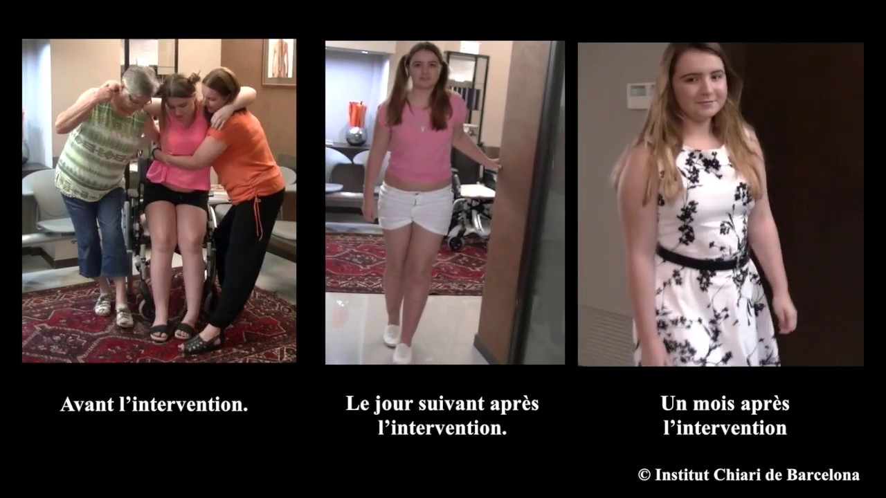 SNCV, Maladie du Filum, Syndrome d’Arnold Chiari I, Syringomyélie et Scoliose idiopathique.