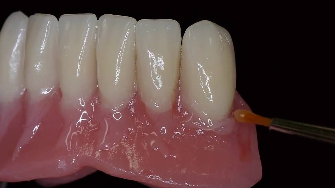 Caracterización de dentaduras con PALA cre-active / OLAF GARZ MDT Alemania