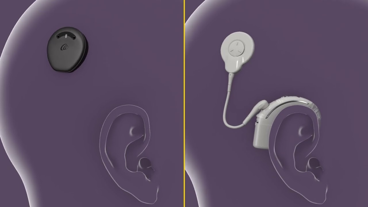 How Cochlear Implants Work