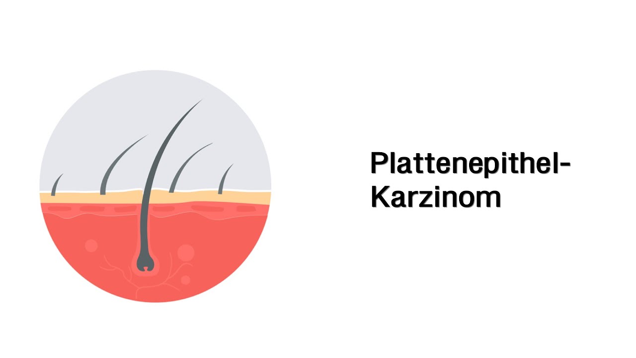 Plattenephitelkarzinom - Erkrankungen der Haut