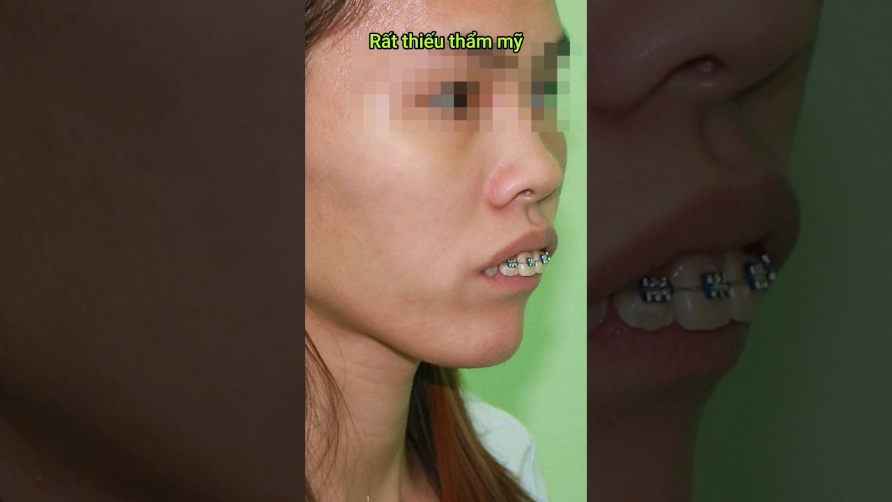 Buck teeth braces #braces #orthodontist #dental #dentistry #niengrang