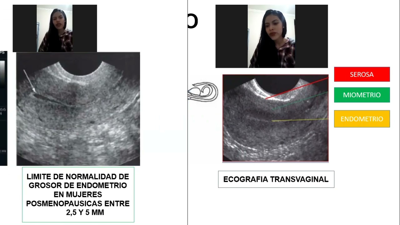 Ecografia Ginecobstetrica - Hidrocefalia