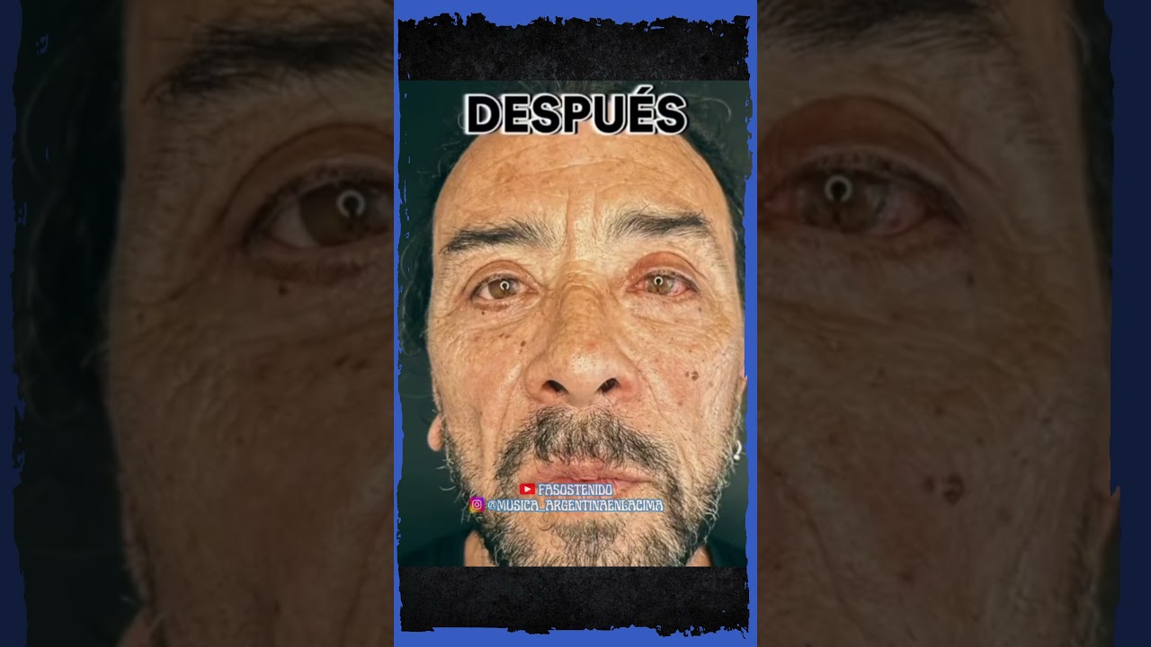 IORIO PREDIJO EL LIFTING CERVICOFACIAL DE O'CONNOR