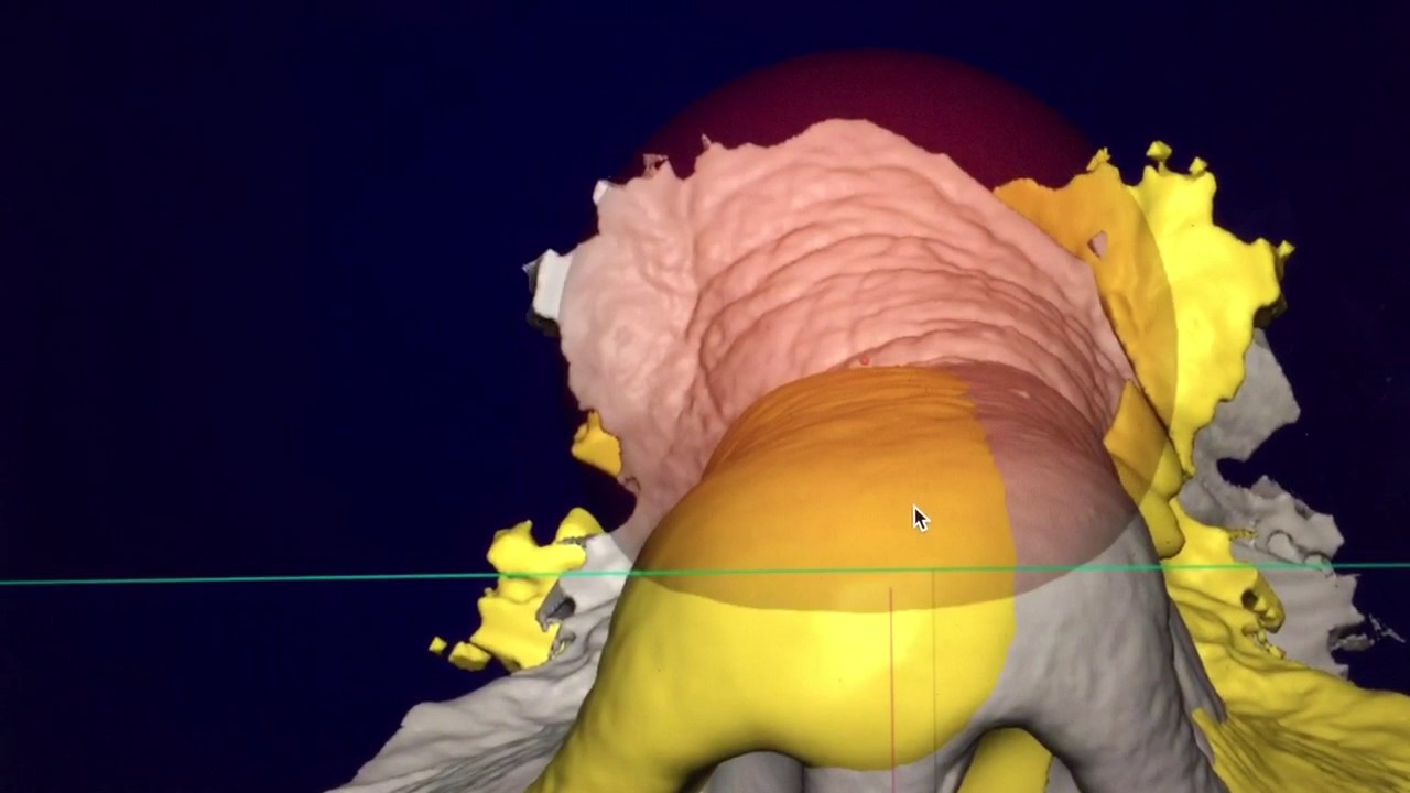 Digital Sculpting A Prosthetic Nose Using Freeform