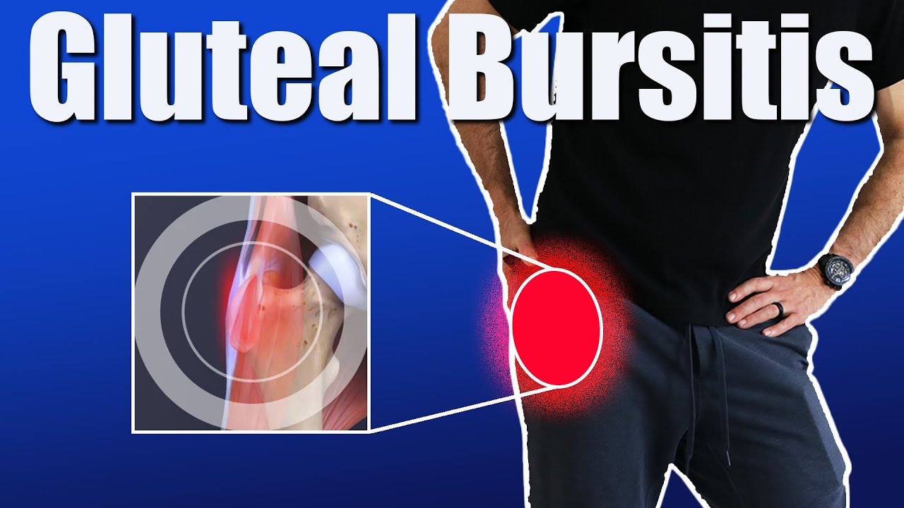 Gluteal Bursitis: Symptoms, Causes, and Effective Exercises for Greater Trochanter Pain