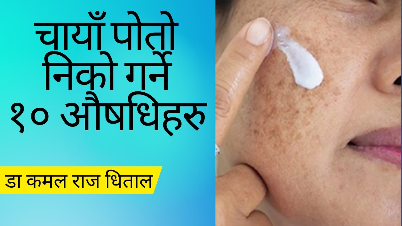 Anuhar ko chaya poto hataune tarika l  poto hataune cream l kalo poto kasari hataune चाया पोतो उपचार