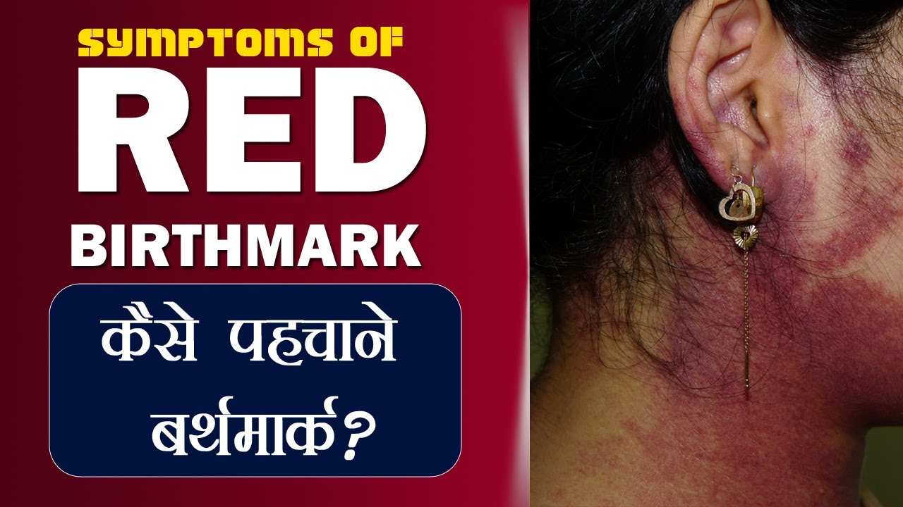 Symptoms of Red Birthmark, कैसे पहचाने बर्थमार्क? (Red, Black Birthmark Symptoms) By Dr. PK Talwar