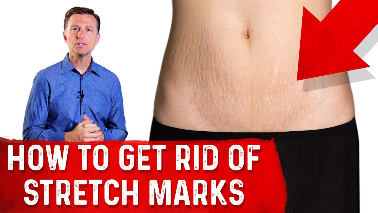 How To Get Rid of Stretch Marks After Pregnancy? &ndash; Dr. Berg