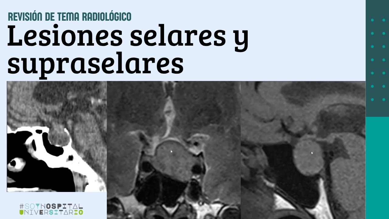 Lesiones selares y supraselares
