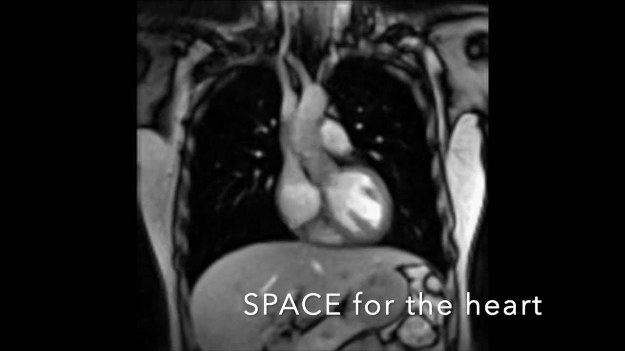 Real-time MRI of Breathing