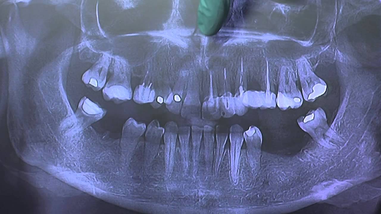 1. Porcelain Veneers - Introduction