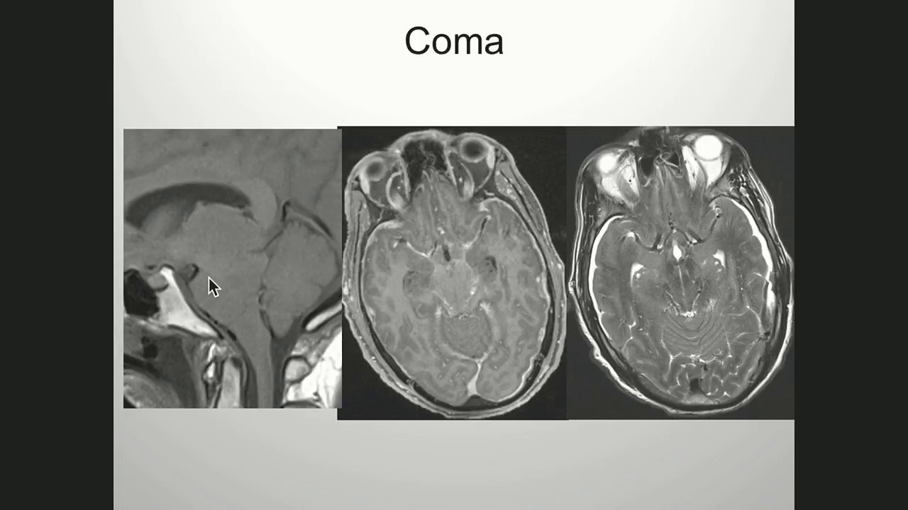 M. Marcel Maya MD - Imaging in Intracranial Hypotension